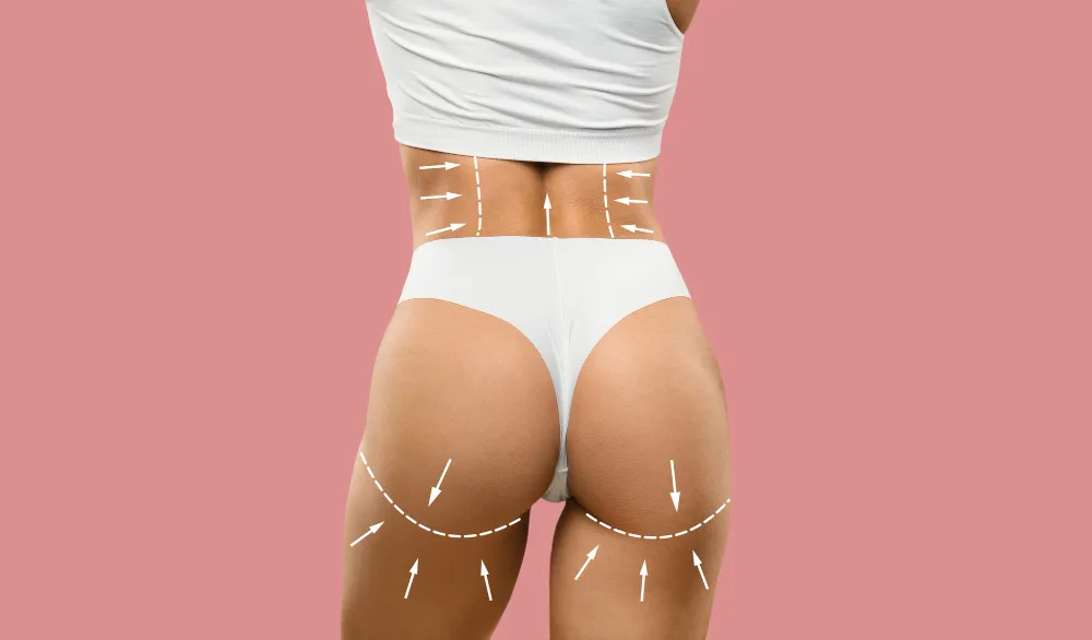 Brazilian Butt Lift Vacuümtherapie Brazilian Butt Lift Vacuümtherapie