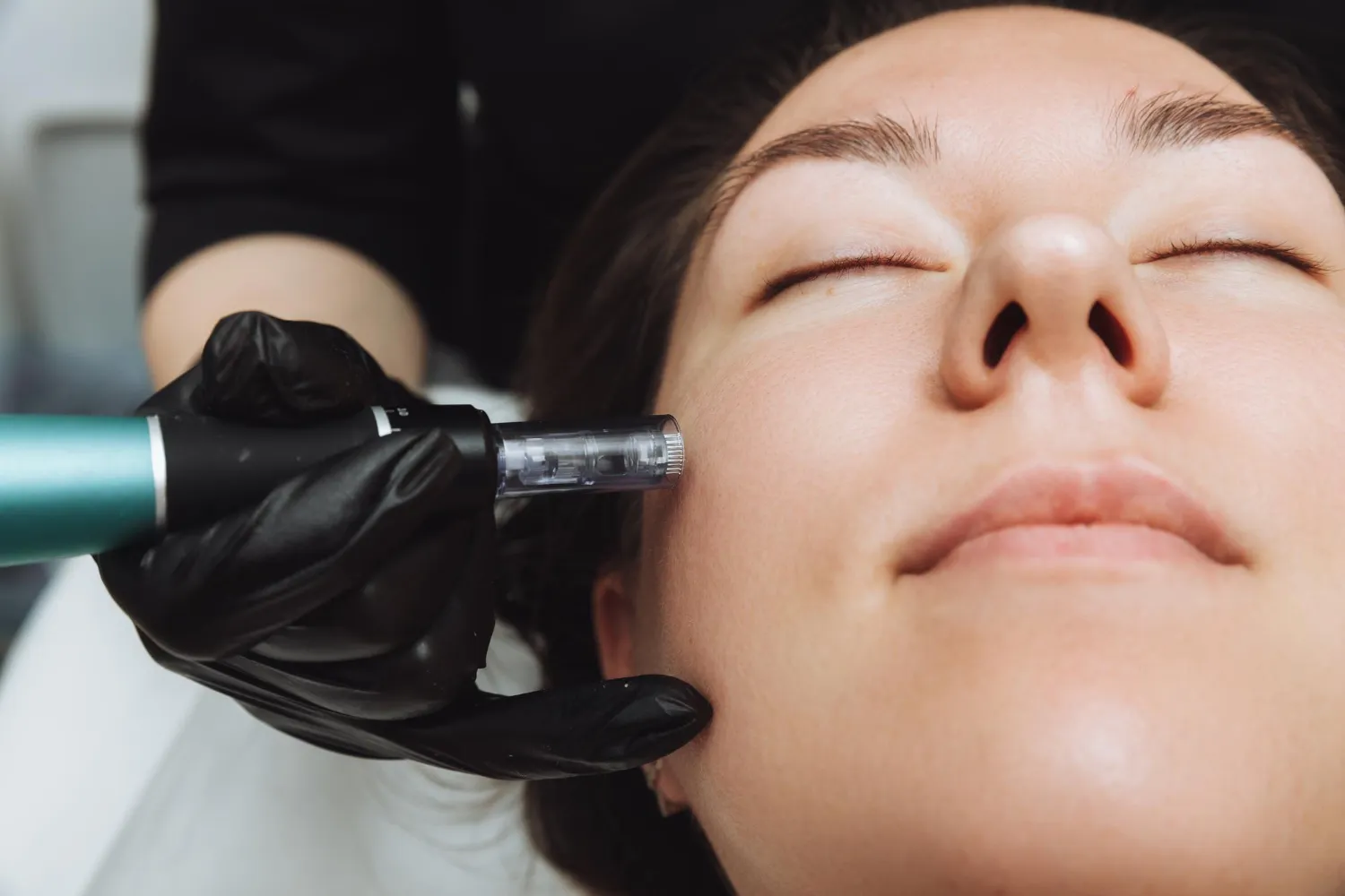 microneedling